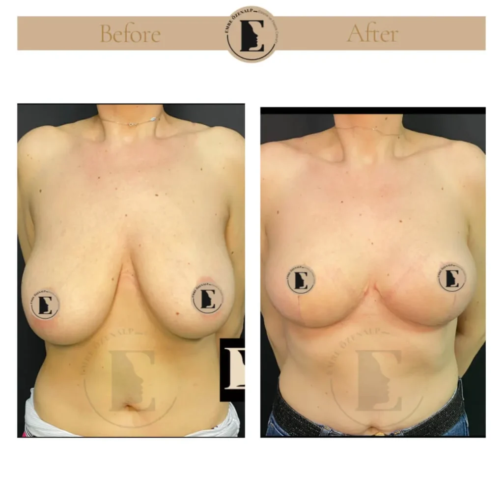 Výsledky modelace (lifting) prsou před a po v Turecku se zkušeným lékařem Emre Özenalpem. Pacientka podstoupila mastopexii v Istanbulu.